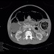 Toxic megacolon, pneumoperitoneum: CT - Computed tomography